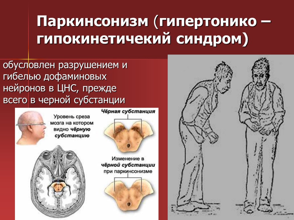 Экстрапирамидная система картинки